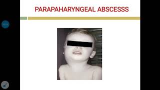 Parapharyngeal abscess [upl. by Kissel622]