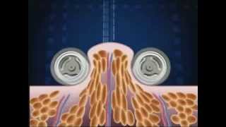 How Endermologie® works lipomassage [upl. by Aset]