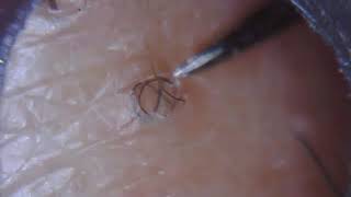 Long ingrown hair removal 23 [upl. by Aicnelav]