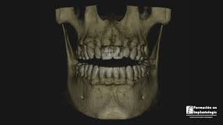 ANTES Y DESPUES CON IMPLANTES DENTALES [upl. by Bertie149]