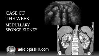 Case of the Week Medullary Sponge Kidney Ultrasound amp CT [upl. by Ellehsal]