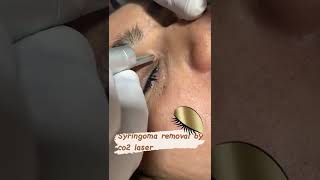 SYringoma removallaser treatmentlaserco2laser [upl. by Louanna]