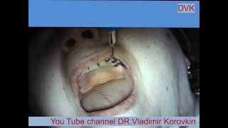 Infiltration Anesthesia for treatment 22 tooth [upl. by Yesoj]