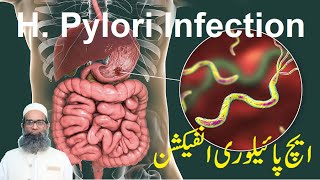 H Pylori Infection Symptoms Spread Risk factors Complications Diagnosis and Prevention  Urdu [upl. by Publias429]