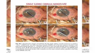 Endothelial keratoplasty DMEK DSEK DLEK PDEK Ophthalmology [upl. by Enej]