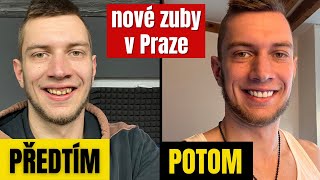 Nové zuby za 1 den v Praze  Vše co ti neřeknou o Fazetách bolest bělení doma stojí to za to [upl. by Yuk]