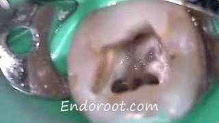 Retratamiento de endodoncia con 3 conductos mesiales [upl. by Mil]