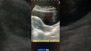 Anteverted uterus ultrasound shortfeed medical uterus pelvic pelvis study shortsviral short [upl. by Case]