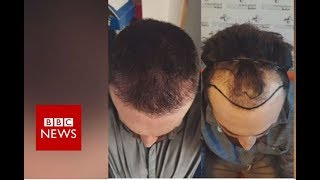 Hair loss Fighting against my receding hairline  BBC News [upl. by Nire36]