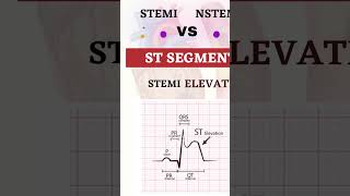 STEMI vs NSTEMI medico shortsvideo shorts nursing stemi nstemi [upl. by Tallia85]