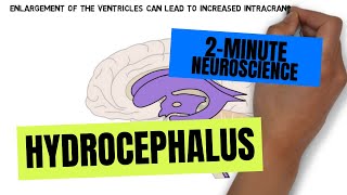 2Minute Neuroscience Hydrocephalus [upl. by Feinstein]