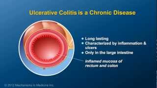 What is Ulcerative Colitis [upl. by Assiralc915]