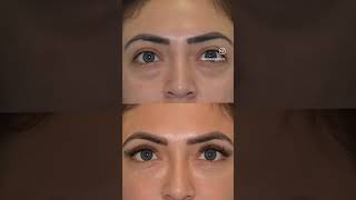 Before amp After Under Eye Filler [upl. by Shultz]