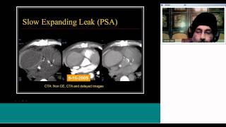 PostOperative Aorta and Stent Graft Imaging by Prof Satinder Singh [upl. by Whitcomb]