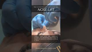 Nose Lift the solution to your asymmetrical or crooked nose [upl. by Anewor]