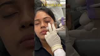 Eye Filler Treatment Watch the Full Process with Dr Anupriya Goel 🌟 eyecare surgerytips [upl. by Harifaz]