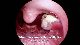 Membranous Tonsillitis [upl. by Ednutey855]