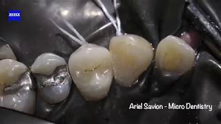 Restoring Teeth without Root Canal Treatment Effective Caries Removal and Crown Restoration [upl. by Liatrice]