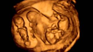 3D ultrasound Dichorionic triamniotic triplets 12 weeks [upl. by Arianne]