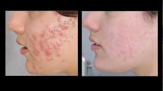 Acne Vulgaris [upl. by Abehsat]