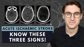 How to read a CT brain scan Acute ischaemic stroke for beginners [upl. by Samella]