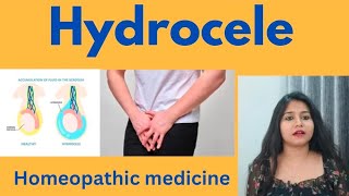 Hydrocele treatment  Hydrocele symptomscauses amp homeopathic medicine in hindi [upl. by Fowle]