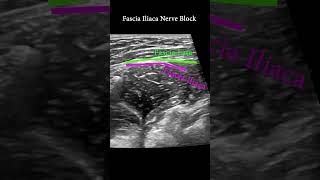 Fascia Iliaca Plane Block ultrasound nerveblock anatomy [upl. by Seadon]