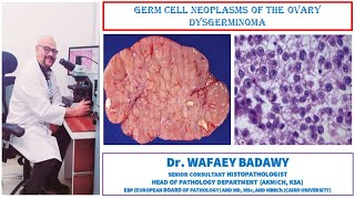 GERM CELL NEOPLASMS OF THE OVARY DYSGERMINOMA [upl. by Ait]