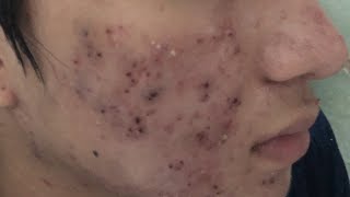 Blackheads Removal 332b  Loan Nguyen [upl. by Johnsson581]