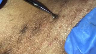 ingrown hair removal 5 [upl. by Yeffej]