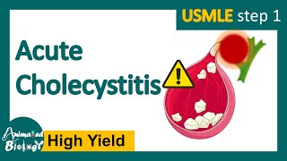 Acute cholecystitis  What is the most common treatment for cholecystitis Pathology of Acute chole [upl. by Enra]