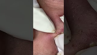 Big Cystic Acne Blackheads Extraction Blackheads amp Milia Whiteheads Removal Pimple Popping shorts [upl. by Tselec315]