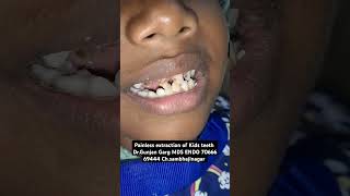 extraction of kids teeth without injection drgunjangarg kidsdentistinaurangabad kidsteethspecial [upl. by Kremer]