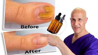 1 Oil Cures Toe Nail Fungus  Dr Mandell [upl. by Ahsile]