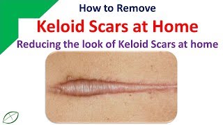 How to Remove Keloid Scars at Home  Reducing the look of Keloid Scars at home [upl. by Maria667]