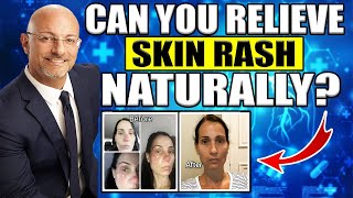 Can You Relieve Skin Rash Naturally  Dr Lonnie Herman [upl. by Walston]