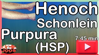 Henoch Schonlein Purpura HSP ׀ Basic necessary facts amp management ׀ Made easy  dr joos [upl. by Siri]