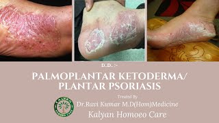 Case of palmoplantar ketoderma plantar psoriasis treatmentampmedicine in HomeopathyDrRavi kumar MD [upl. by Thill459]