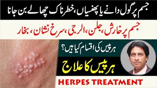 What is Herpes  Herpes ka ilaj  Herpes trearment in urdu  Dano ka ilaj  Dr Jahangir Yasir [upl. by Akimert]