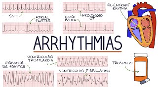 Understanding Arrhythmias [upl. by Eanrahc970]