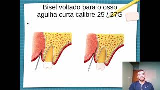 Técnicas de Anestesia Maxilar  SupraperiostealSubperiosteal Malamed Odontologia [upl. by Donough384]