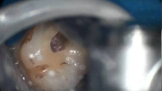 first upper molar conservative endodontic access [upl. by Gibert]