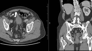 Unilateral renal seminal vesicle and Vas deferens agenesis [upl. by Novihs]