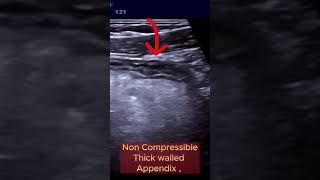 When Appendix becomes Infected and Complicated ultrasound appendicitis intestine [upl. by Nnylyrehc]