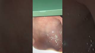 Upper endoscopy of a child with persistent vomiting one year ago showing gastritis and duodenitis [upl. by Aliuqaj493]