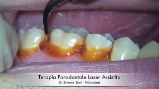 Terapia Parodontale Laser Assistita [upl. by Meldoh689]