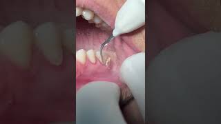 Scaling tartar and calculus dental [upl. by Areema514]