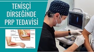 Tenisçi Dirseğinde Lateral Epikondilit PRP Tedavisi [upl. by Opiuuk]