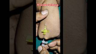 IV cannula technique IV cannula kaise lagate hain viralvideo viralshort shorts cannulatechnique [upl. by Ahsirak]