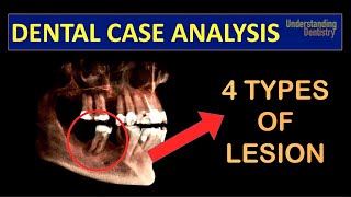 TRY TO DIAGNOSE A Case with 4 TYPES of PERIAPICAL LESIONS radicular cyst close to IAN Dental Quiz [upl. by Wes976]